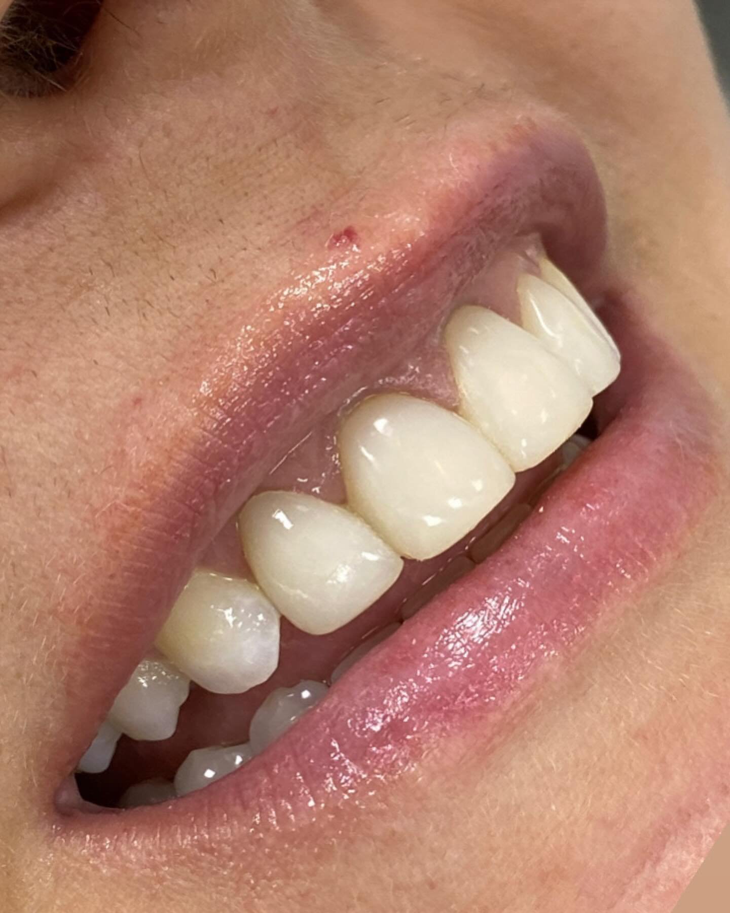 Sorriso antes das facetas de resina composta