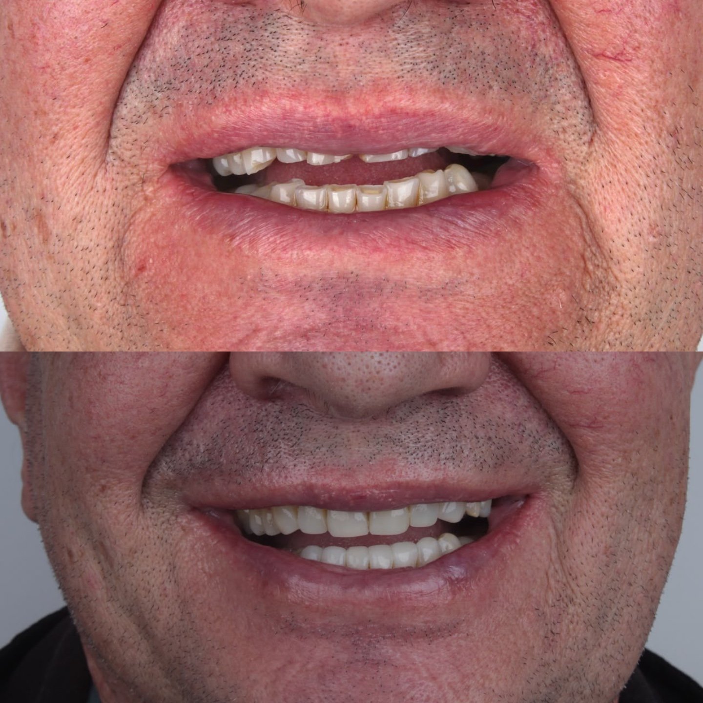Antes e depois de facetas de resina composta