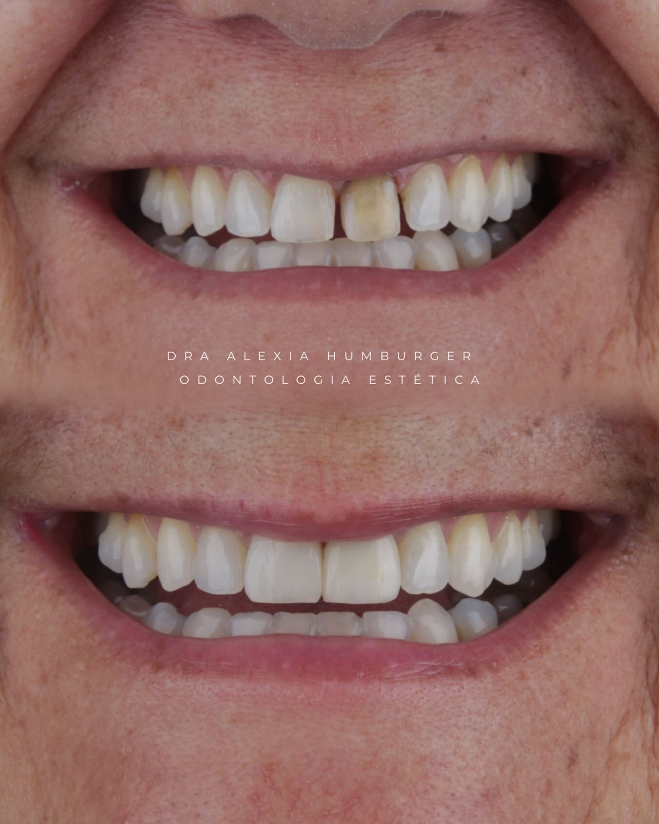 Correção de desgaste dental com resina composta