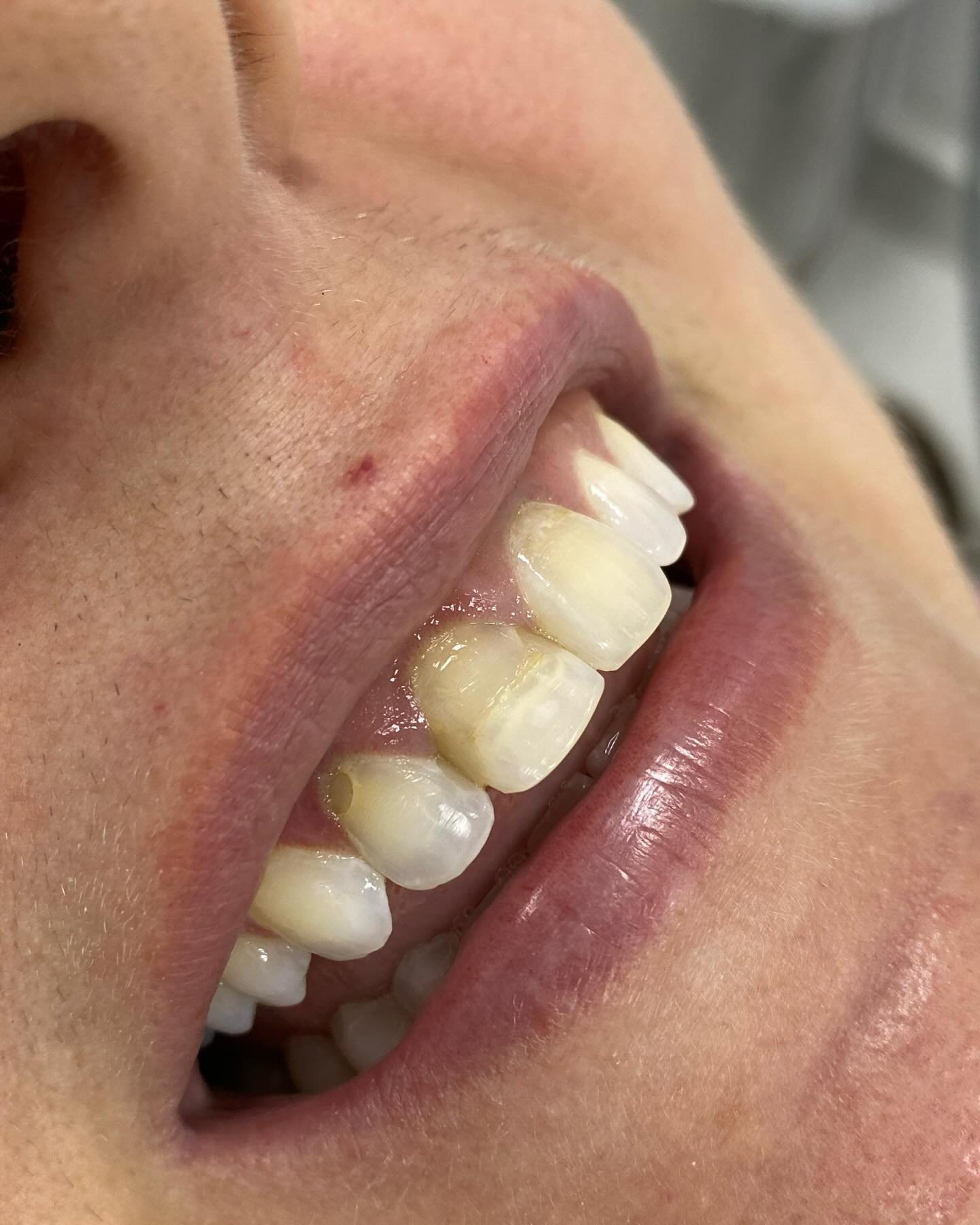Sorriso depois das facetas de resina composta